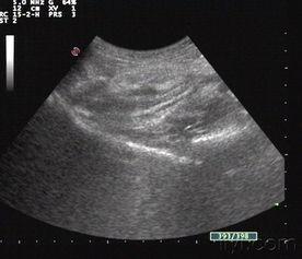 阑尾炎照片,直观解析与病例分析